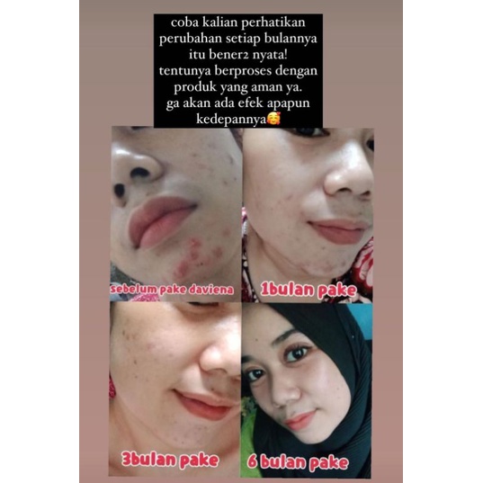 Daviena skincare medan - Acne series Komplit / Paket Hemat Acne 1-2 Best seller-5