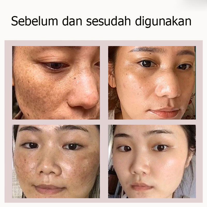 krim penghilang melasma Krim Pemutih Wajah Krim Penghilang Bintik Hitam 30g meringankan melasma dan bintik-bintik Mencerahkan kulit Mengurangi kulit kusam