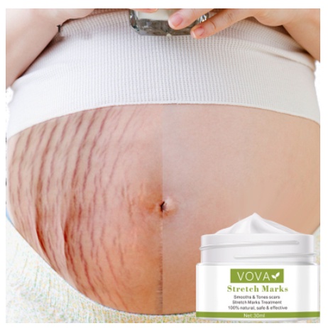 Krim Kehamilan Stretch Mark Cream Krim Kerut 30 Ml Postpartum Perbaikan Pinggang Perut Bokong Stretc