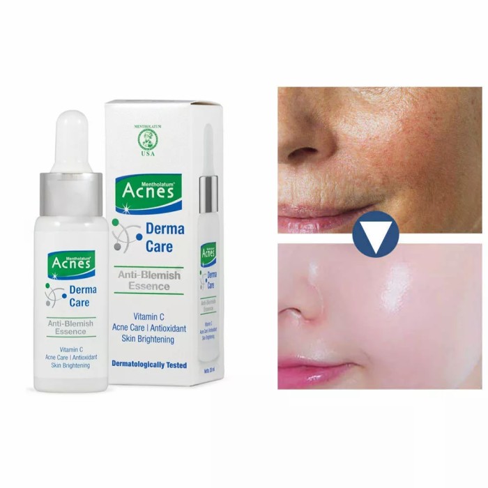 Acnes Derma Care Anti Blemish Essence 20 ml