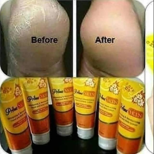 PRIMESKIN LOTION hilangkan bekas luka cacar bekas knalpot kulit putih cerah alami