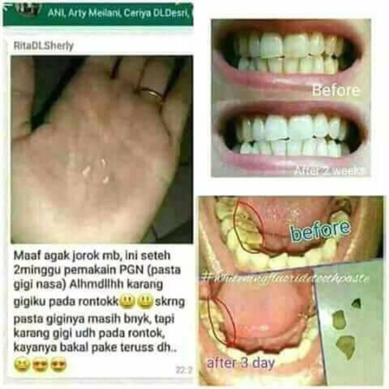 Perontok karang Gigi