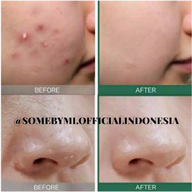 Image of SOMEBYMI Some By Mi 30 days Miracle Toner AHA-BHA-PHA 150ml Obat Jerawat Ampuh #4