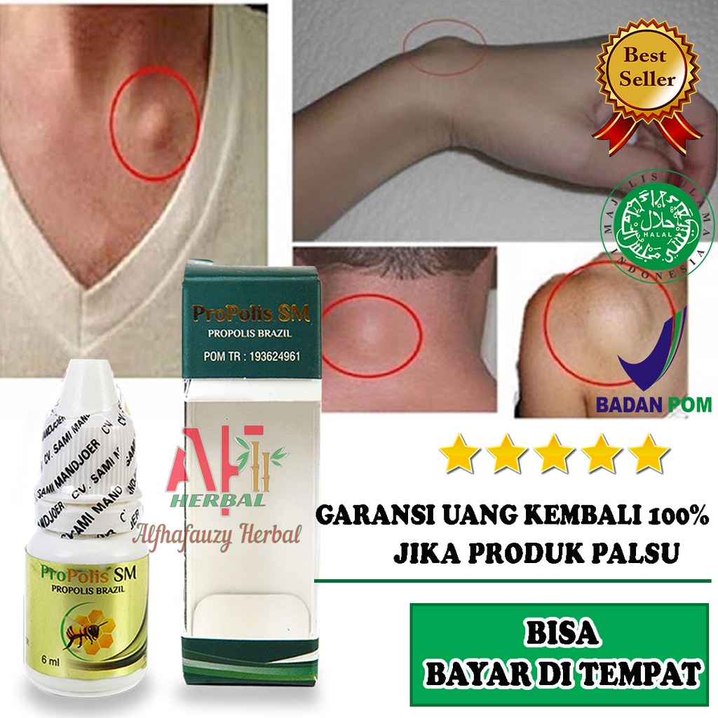 Obat Lipoma - Benjolan Besar - Benjolan Kecil Di Tubuh Leher Kepala Dahi Tangan Propolis Sm brazil O
