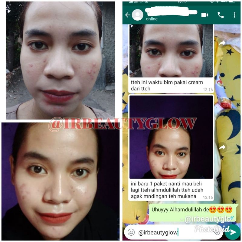 Irbeautyglow acne, cream untuk kulit berjerawat,cream farmasi berkwalitas