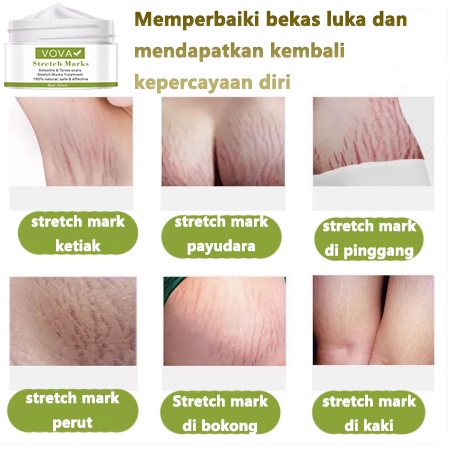 Stretch mark cream Krim Penghilang bekas luka  Krim Kehamilan Hilangkan stretch mark Obat Penghilang Strechmark Paling Ampuh Untuk Ibu Hamil Setelah Melahirkan Mama's Choice