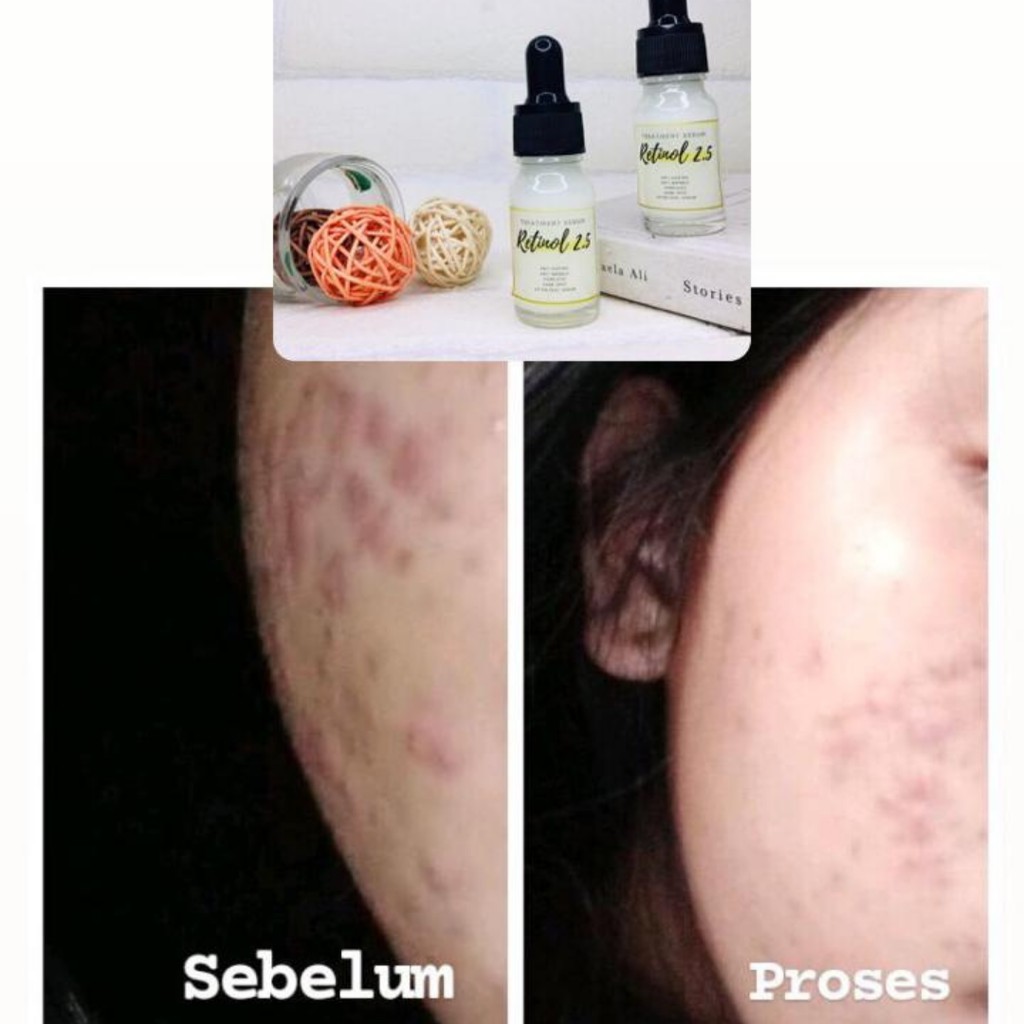 anti aging peeling gél