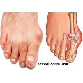 Penyebab Asam Urat Pada Lansia Ketahui Dan Pahami