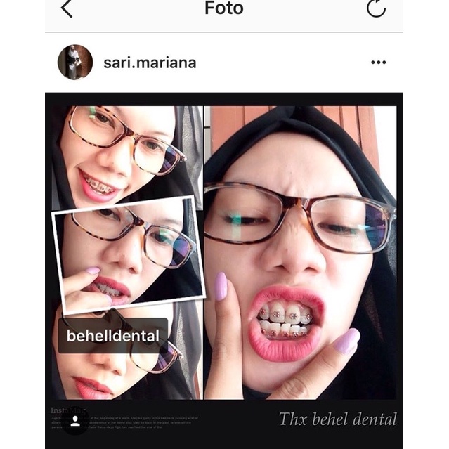 ORIGINAL BRACKET BEHEL GIGI METAL METALIC ORTHO FDA / AEGIS / GEOUSIS / LUXURY MINI ROTH MENGKILAP WITH HOOK on 3 - Dental Braces Orthodontic Untuk Perbaikan / Perawatan Gigi - Kawat - ANTI KARAT - Metalic