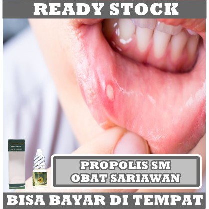 Obat Sariawan Mulut, Bibir, dan Lidah - Obat Sariawan Alami untuk Anak dan Dewasa - Propolis untuk Sariawan ProPolis SM 6ml Sudah BPOM