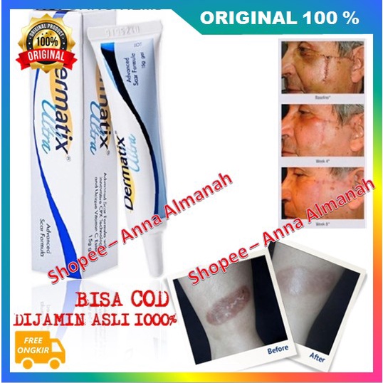 PROMO Dermatix Ultra Gel Penghilang Bekas Luka / Keloid ANTI SCAR Stretchmark Perbaikan Kulit Terbuk