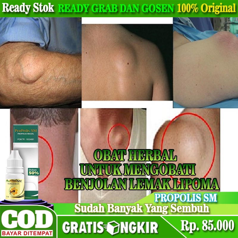 Obat Penghancur Benjolan Lemak Lipoma, Obat Lipoma Herbal, Penghancur Benjolan Lipoma Di Tubuh, Obat