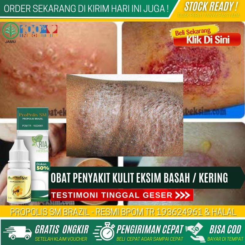 Obat Pengering Luka Eksim, Obat Penghilang Bekas Luka Eksim, Eksim Pada Telapak Tangan, Menghilangka