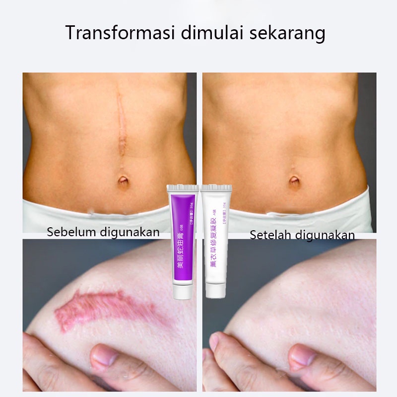 Krim penghilang bekas penghilang bekas luka penghilang bekas jerawat 60g Menghilangkan bekas luka dengan cepat dan lembut stretch mark bekas jerawat mengembalikan kulit halus