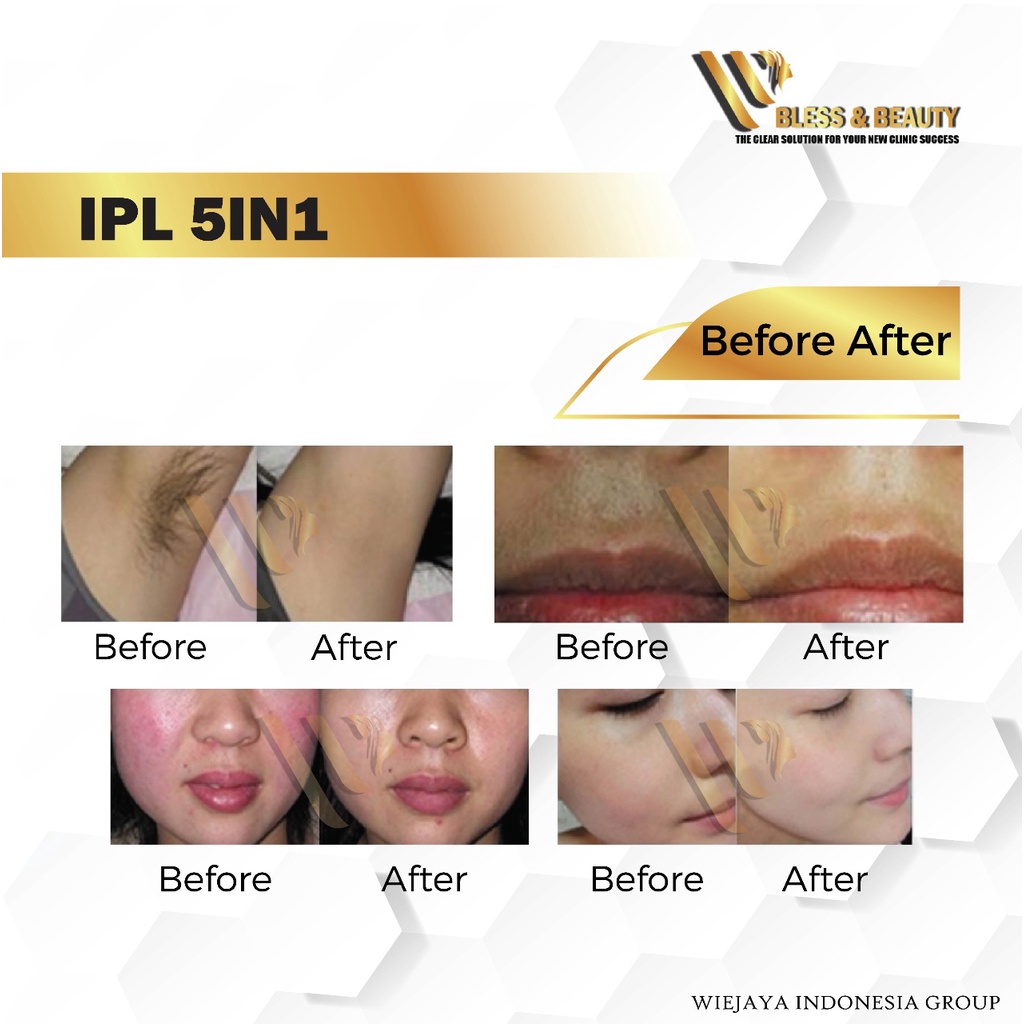 IPL Hair Removal 5in1 Alat laser hair removal penghilang bulu Ipl  Dengan 500,000 Shoot [PROMO]