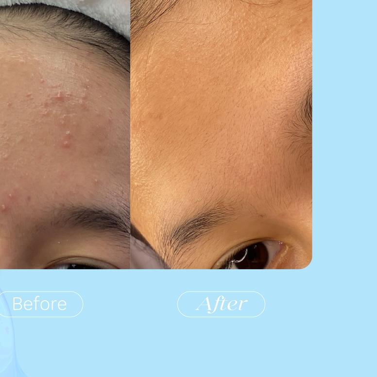 Reluvie Acne Serum