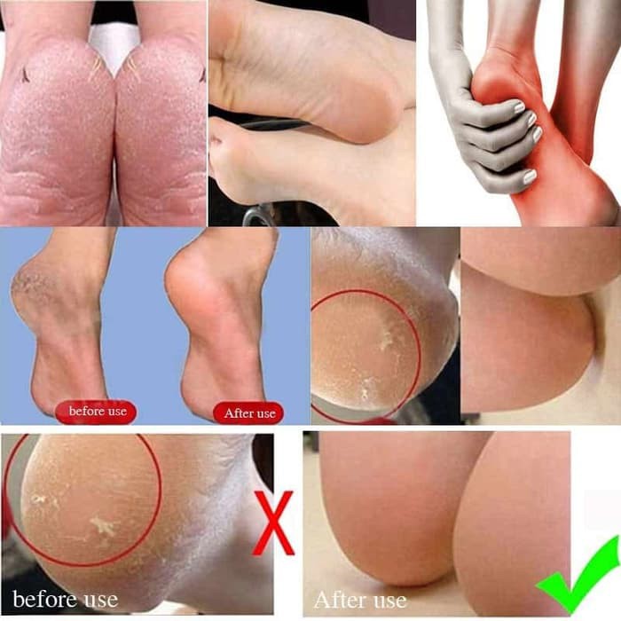 ANTI CRACK SILICONE SOCKS SILICONE ANTI KULIT KAKI PECAH KERING KASAR