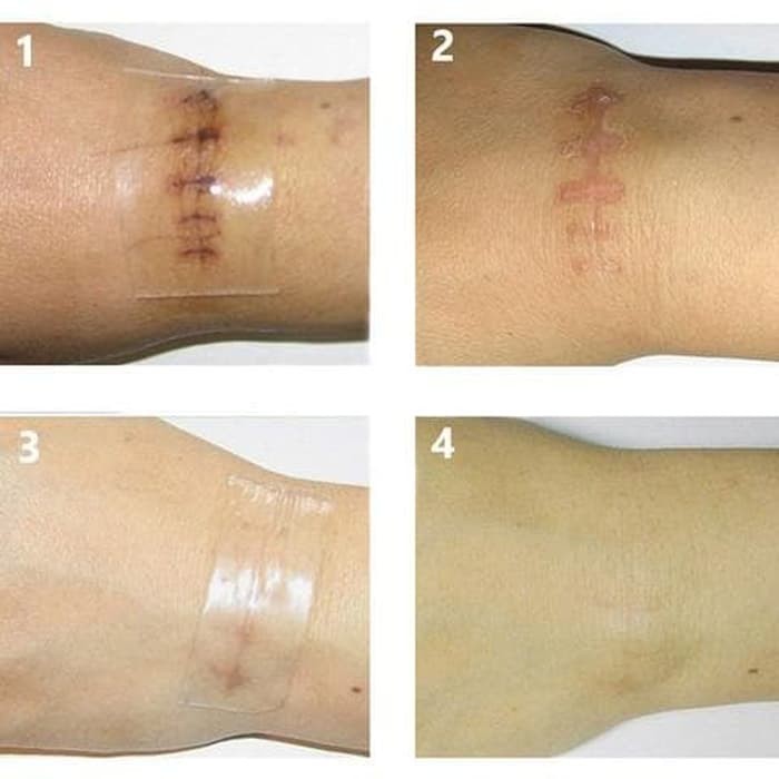 OBAT PENGHILANG LUKA SCAR REMOVAL SILICONE PATCH TRETCH MARK