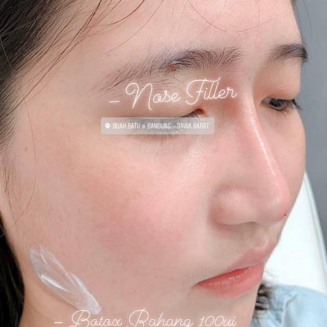 Filler hidung dagu bibir dan mata