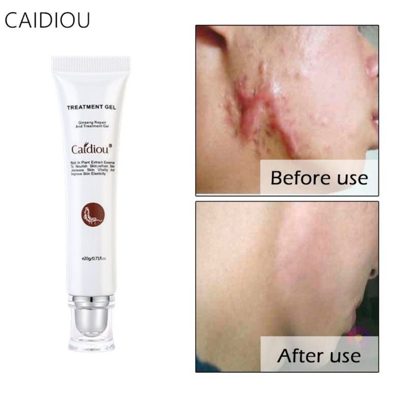 Caidiou Ginseng Repair Acne Scar essence Cream Whitening For Face Or Body Surgery Scar Cream 20g