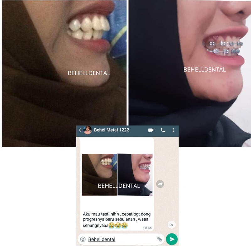 ORIGINAL BRACKET BEHEL SINYE S-ORTHO Mim Mini Roth With Hook // Bracket Kawat Gigi Ortho Untuk Perawatan / Perbaikan / Metal Metalic Metalik Braces Orthodontic / Behelldental Silver