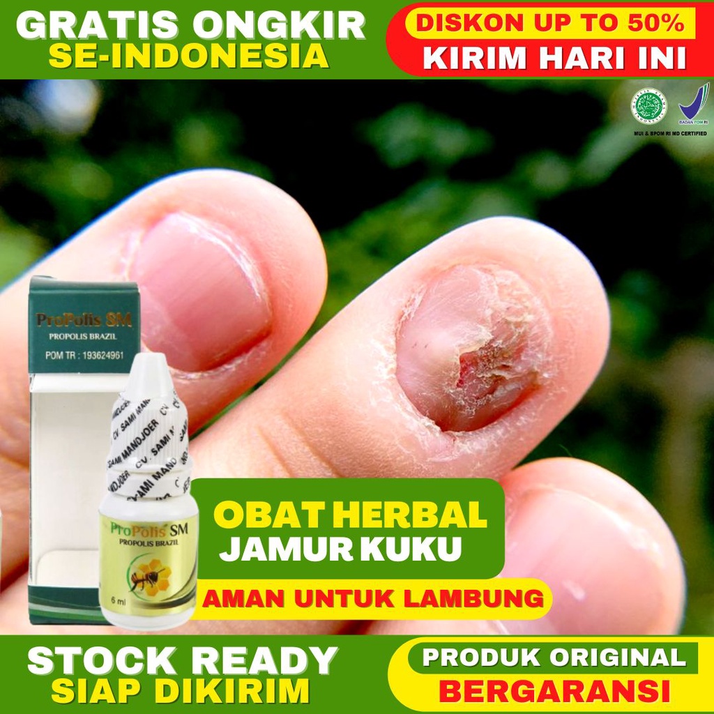 Obat Jamur Kuku Obat Infeksi Jamur Kuku Kaki Tangan Kuku Berjamur Rusak Propolis SM Original