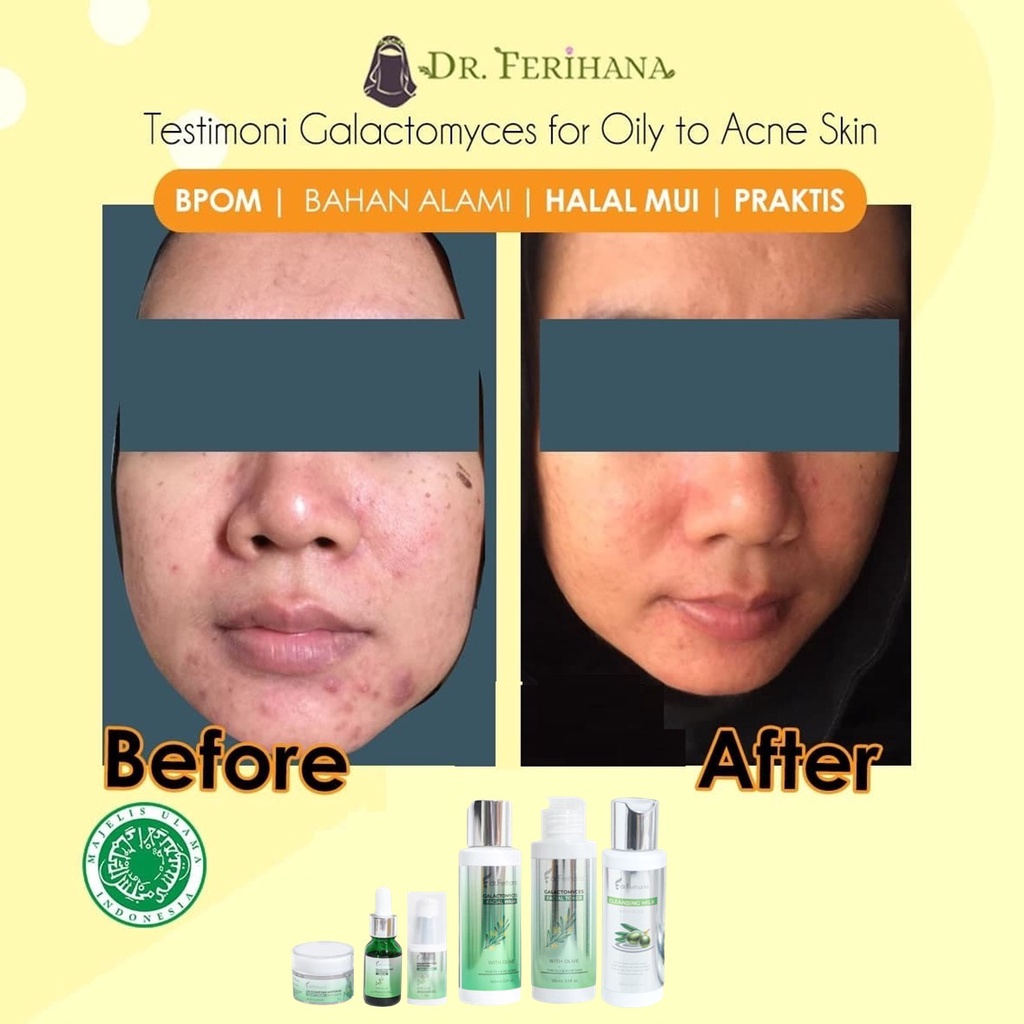 Paket Premium Galactomyces Whitening for Oily &amp; Acne Skin dr. Ferihana Cosmetics &amp; Skincare Paket Perawatan Wajah untuk Kulit Berminyak Berjerawat Ringan Sedang sampai Meradang Bernanah Sekaligus Mencerahkan Memudarkan Bekas Anti Aging BPOM LPPOM HALAL