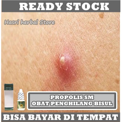 Obat Penghilang Bisul, Obat Benjolan Bernanah, Obat Bisul Di Tangan, Obat Bisuk Di Kaki, Obat Bisul Di Wajah, Obat Bisul Di Pantat, Obat Bisul Di Penis, Obat Bisul Di Vagina, Obat Bisul Di Payudara, Obat Bisulan Dengan Propolis SM