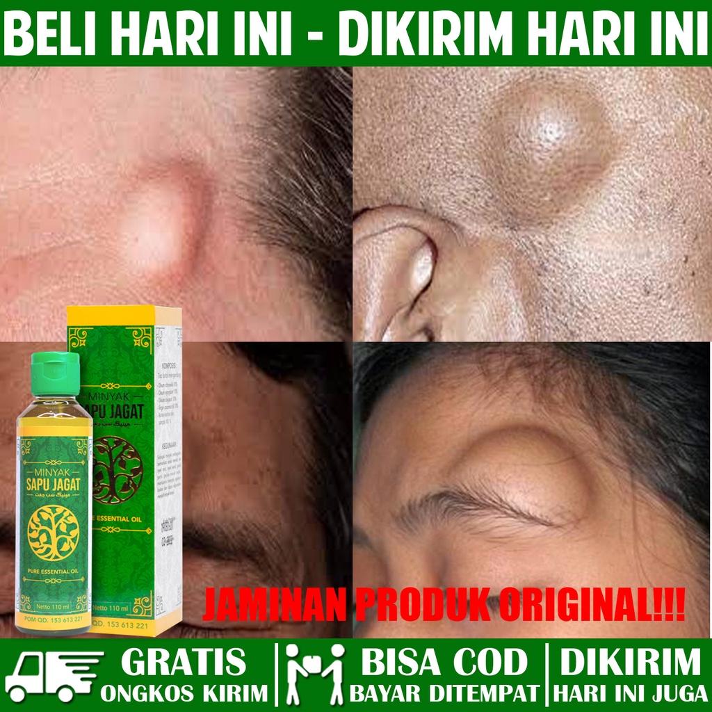 Minyak Sapu Jagat Asli - Obat Oles Untuk Benjolan Di Kening Jidat, Benjolan, Benjolan Lipoma Di Keni