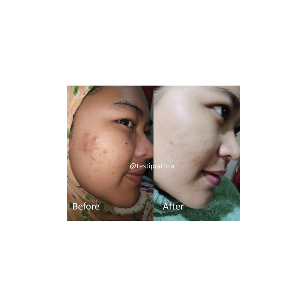 Centella Enrich Cream Men : Membantu Merawat Kulit Bopeng Untuk Pria