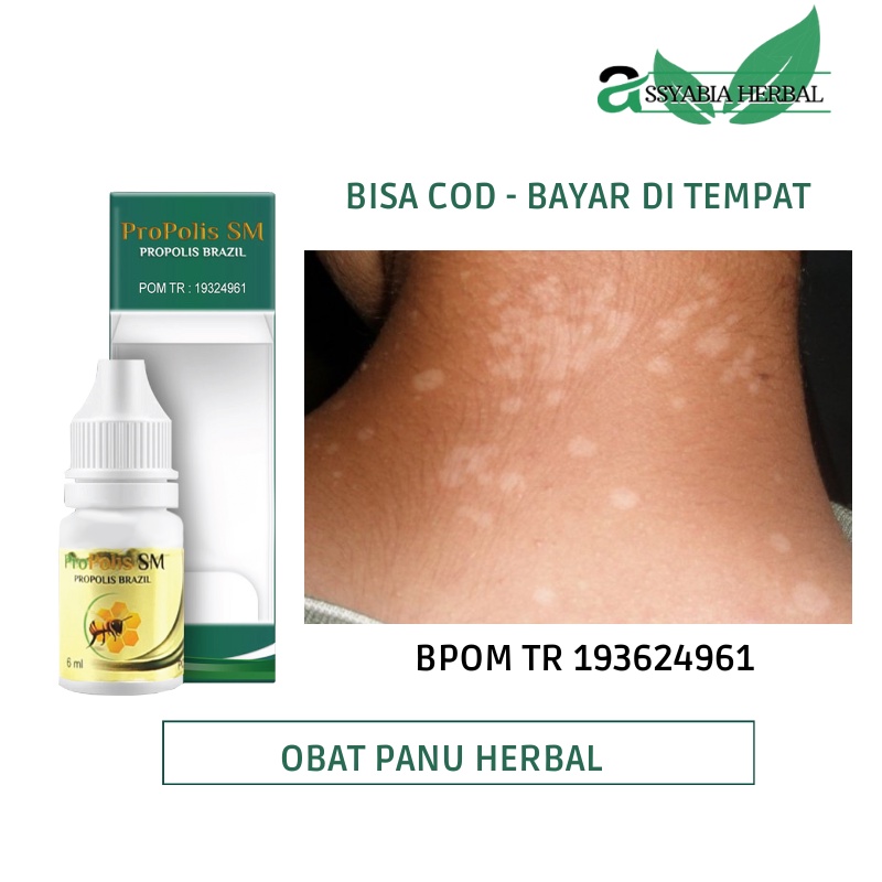 Obat Panu, Penghilang Panu Anak, Panu di Wajah, Panu Cair, Bercak Putih di Wajah, Hapur, Jamur Kulit