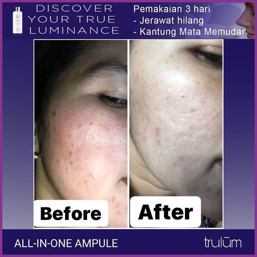 µ896£ Serum Ampuh Untuk Jerawat / Cream Untuk Memutihkan Kulit Wajah Pria Secara Alami Trulum