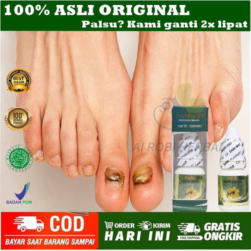Obat Kuku Kaki Jamur Rusak Bau Busuk, Obat Psoriaritas Kuku, Obat Kuku Rusak , Obat Kuku Busuk