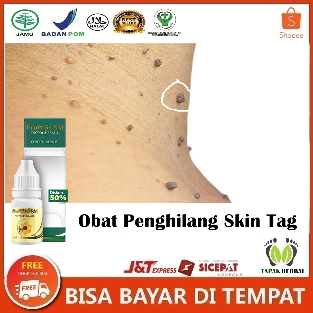 Obat Penghilang Skin Tag, Obat Daging Tumbuh Di Leher, Papilomam Skin Tag di Wajah, Daging Jadi Mena