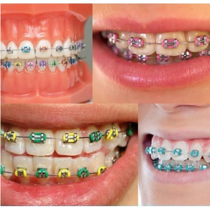 Perpaduan Warna  Karet  Behel  Yang  Bagus 