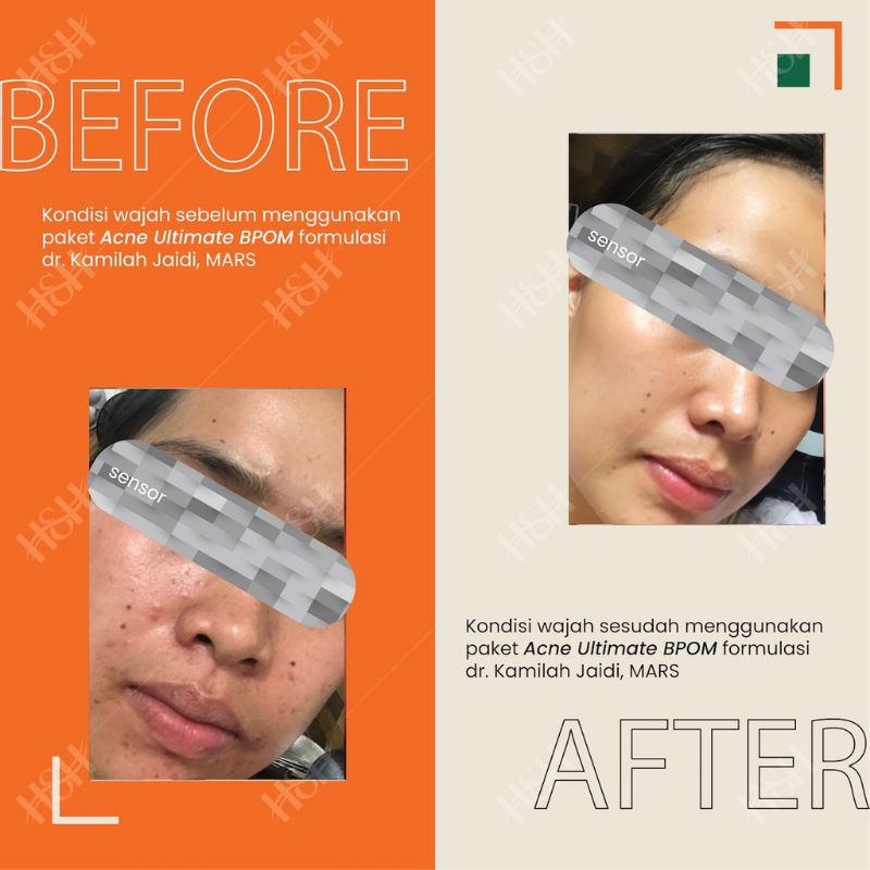 H&H Paket Acne Ultimate Bpom Perawatan Wajah Atasi Jerawat Sedang / Acne Prone Skin-4