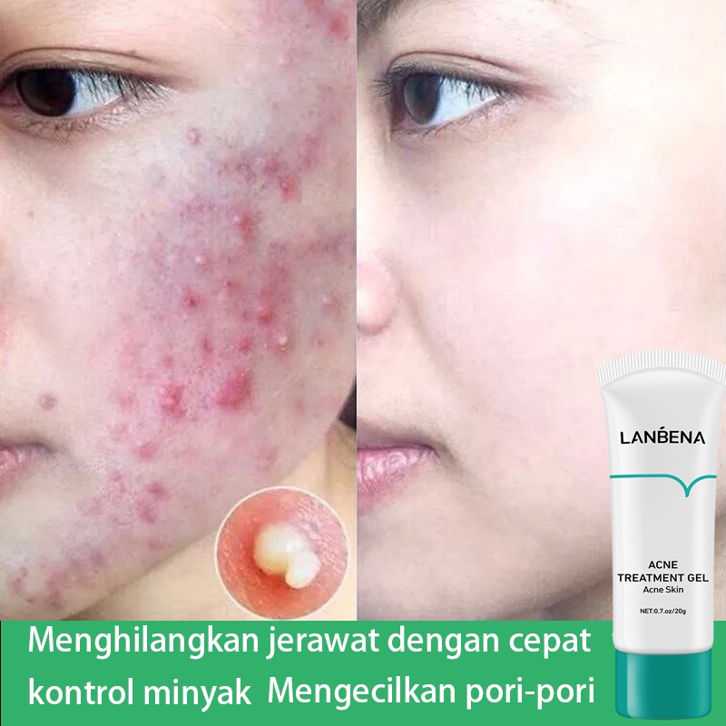 Penghilang bekas jerawat obat jerawat Serum jerawat  Obat jerawat  Salep jerawat   Removal Spot Care Menghilangkan jerawat dengan cepat Aman dan efektif