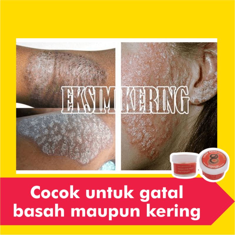 Salep Obat Gatal Eksim Kering Basah Menahun Paling Ampuh Kurap Panu Selangkangan Jamur Gatel Kulit-4