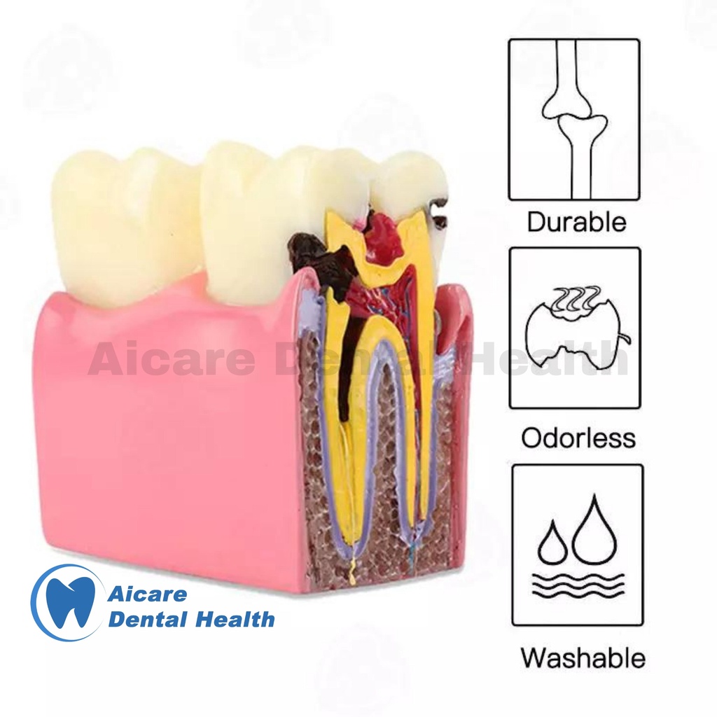 Dental Model 6X Tooth Decay 2 Side - Model Gigi Karies 6X 2 Sisi