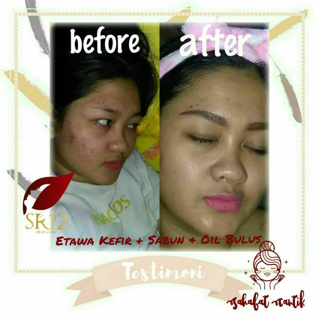 PAKET PEMULA KULIT KUSAM - FLEK HITAM - BEKAS JERAWAT - NORMAL