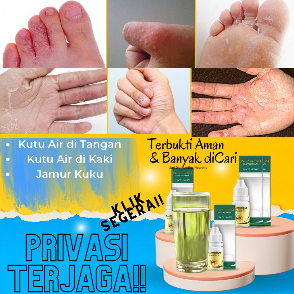 [ BISA COD - 100% ORIGINAL ] Obat Kutu Air, Obat Kutu Air Pada Kaki, Obat Kutu Air di Jari Tangan, K