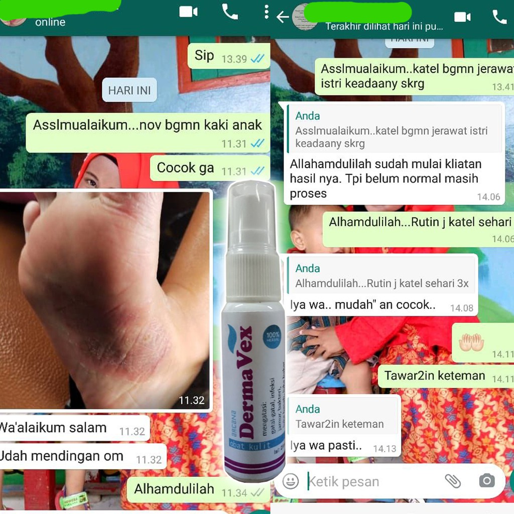 OBAT KULIT TERBAIK, ALERGI, JAMUR, GATAL GATEL LEHER, PANU, EKSIM, DLL-2