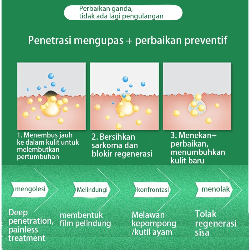Cairan Obat Untuk Kutil Plester Kutil Mata Ikan Kaki Kapalan Ji Yan Gao Obat Kutil Kapalan Mata Ikan Kaki Callusol / Calusol / Kalusol (Mata Ikan Kalusol, Obat Kutil)
