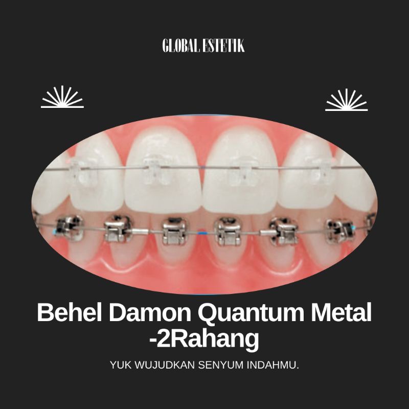 Behel Damon Quantum Metal -2Rahang