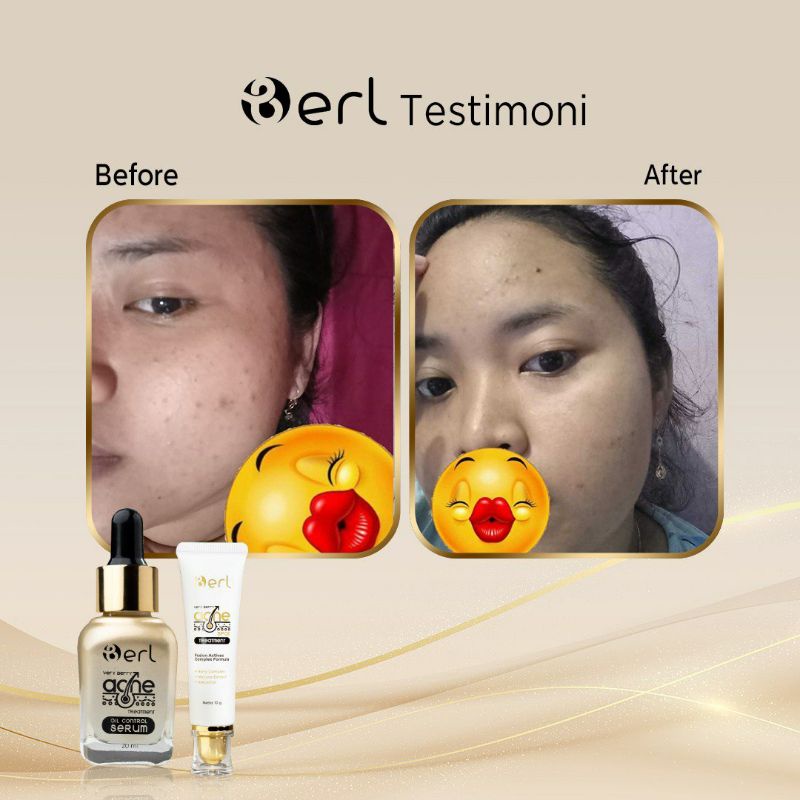 Acne Serum, Penghilang jerawat kulit berminyak