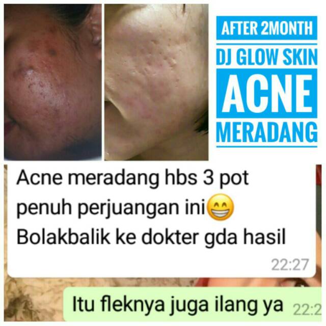 Dj Glow Skin Acne Skin Paket Acne (Paket Kulit Berjerawat)