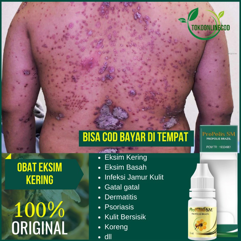 Obat Eksim Kering Basah Menahun Scabies Dermatitis Seboroik Gatal Kulit di Kaki Tangan Seluruh Badan