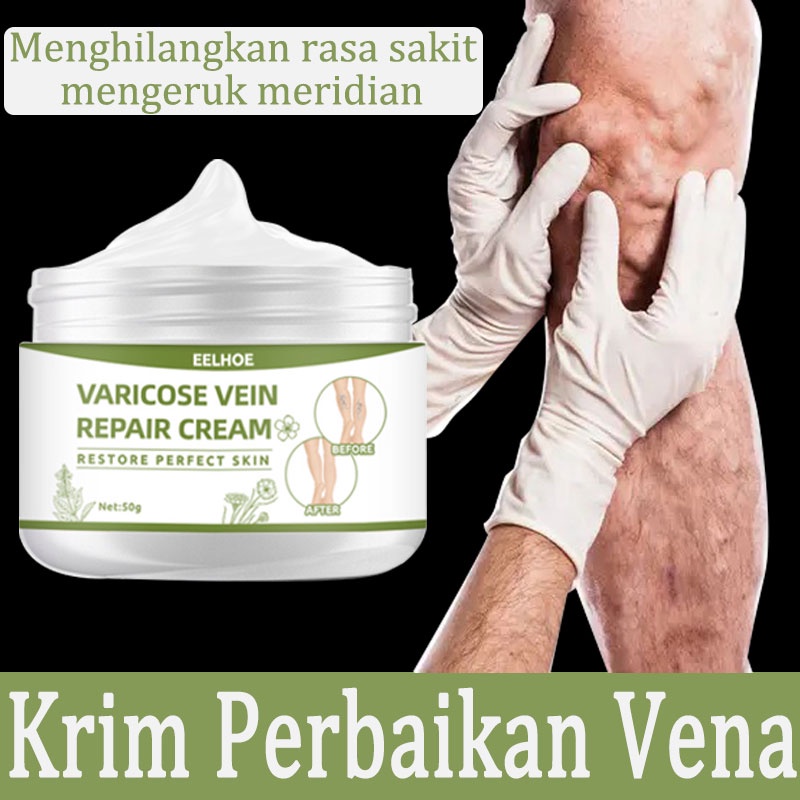 Varises salep penghilang bekas luka varises salep herbal 50g vaskulitis Menghilangkan rasa sakit, membuka sumbatan otot