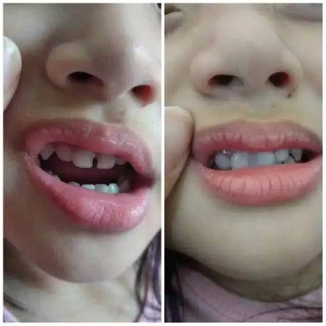 tambal gigi instant tanpa ribet gigi kelinci gigi gingsul