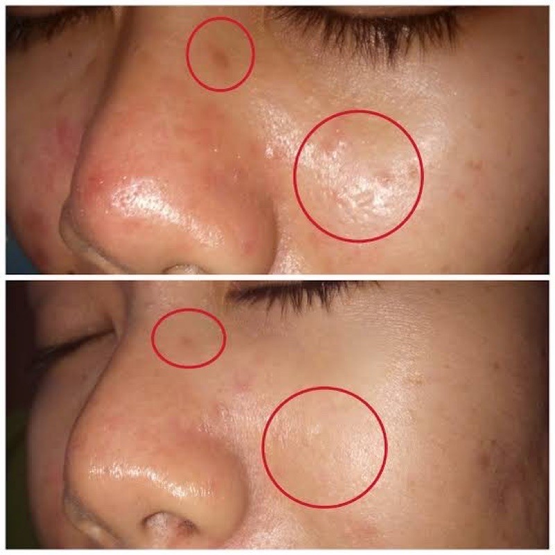 Beautee Nano Scar / CAVIAR / 24K / Hydro lighting / PUMPKIN / CAVIAR Bopeng Bekas Jerawat 1 bj